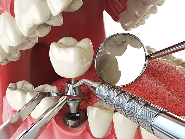 Best Urgent Care for Lost Fillings or Crowns in West Falmouth, MA